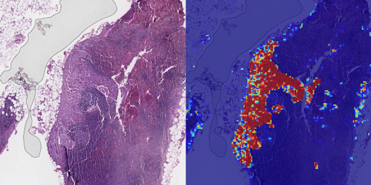 Google Ai Can Now Spot Breast Cancer Better Than Humans